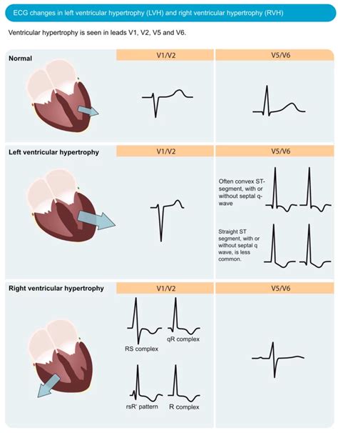 ecg lv strain|ecg findings in lvh.